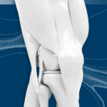 The use of injectable orthobiologics for knee OA